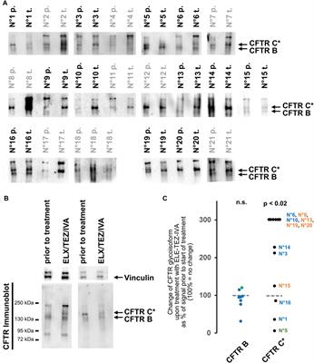 Changes in cystic fibrosis transmembrane conductance regulator protein expression prior to and during elexacaftor-tezacaftor-ivacaftor therapy